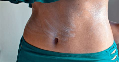Hives On Stomach Causes Treatments And More