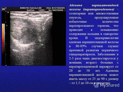 Диета при аденоме щитовидной железы Диета При Аденоме Паращитовидной Железы — Похудение Диета Правильное Диета При Аденоме Паращитовидной Железы — Похудение Диета Правильное Диета при аденоме щитовидной железы