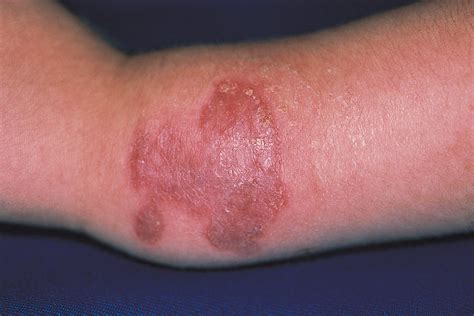 Skin Ulcers Associated With A Tender And Swollen Arm Dermatology