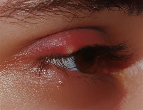 Swollen Eyelid Infection Eye