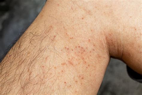 Skin Disease Winter Healthcare Dry Cracking Skin And Rash Red Of Leg