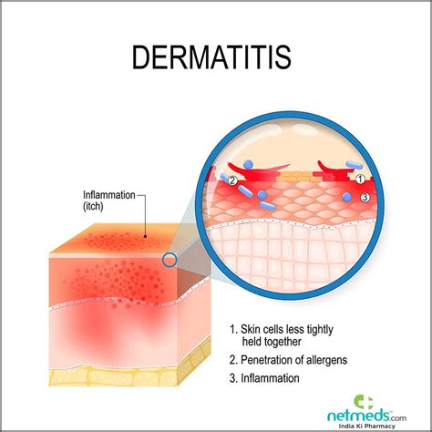 Contact Dermatitis Causes Natural Treatments Contact Dermatitis