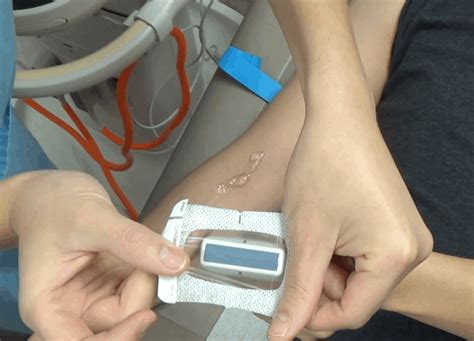 Ultrasound Guided Peripheral Iv Insertion Placement And Access Made