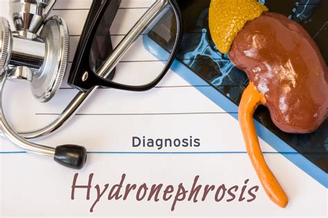 Understanding Hydronephrosis Causes Symptoms And Treatment Facty