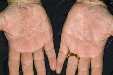Psoriasis On The Palm Of The Hands Stock Image C0085734 Science