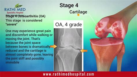 Osteoarthritis An Introduction Joint Pain Causes Stages Of