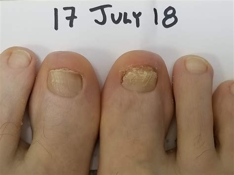 Run With Perseverance A Tale Of Two Toenails How To Fix Runners Toenails