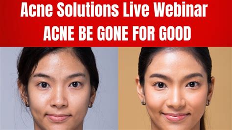 Unraveling Acne Solutions In Part 2 Live Webinar Youtube