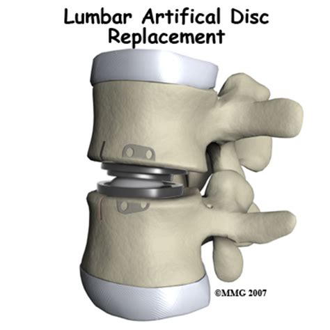 Artificial Disc Replacement Surgery An Alternative To Lumbar Fusion