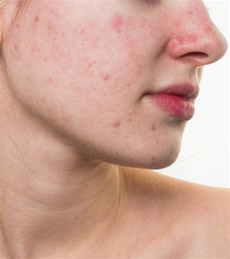 Overcoming Red Spots On The Face Like Acne Healthreplies