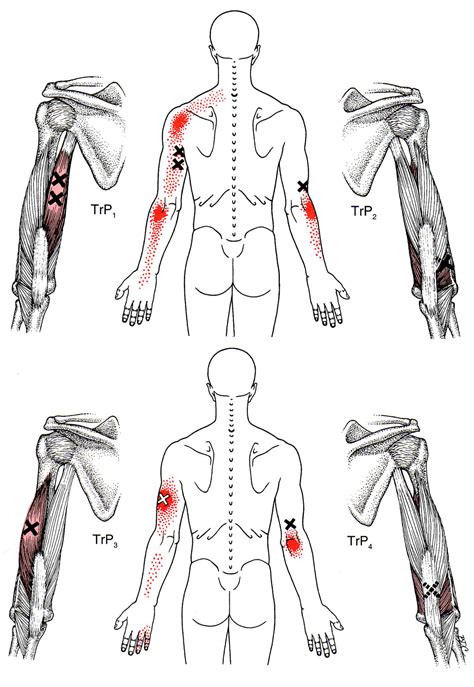 Arm Muscles Map Triceps Brachii The Trigger Point And Referred Pain