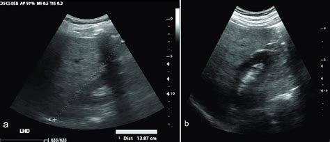 Diffuse Hepatic Steatosis Diffuse Hepatic Steatosis Seen On Standard