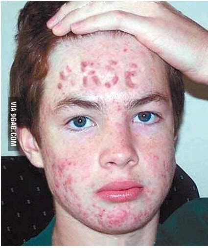 Worst Case Of Acne In History