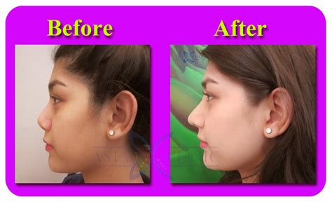 Rhinoplasty Surgery Thailand Nose Augmentation Before And After Photos