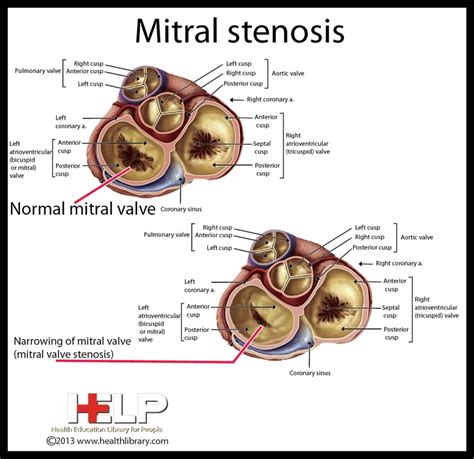 Mitral Stenosis Diagnostic Medical Sonography Nursing Notes Medical