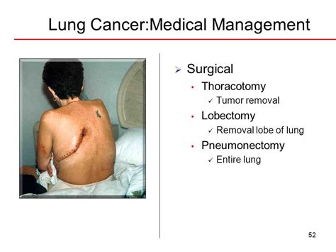 Lung Cancer Surgical Procedure Do Away With Lobe