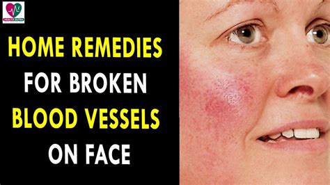 Home Remedies For Broken Blood Vessels On Face Health Sutra Best