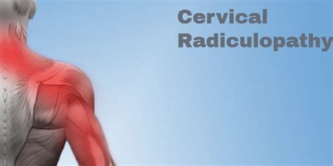 Cervical Radiculopathy Symptoms And Treatments Legacy Spine