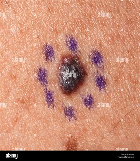 Malignant Melanoma Stock Image C0381679 Science Photo