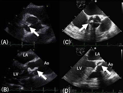 A Calcified Amorphous Tumor Originating In The Aortic Valve Cusp The