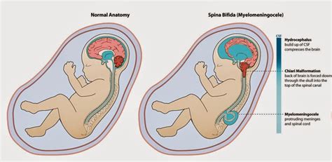 Neural Tube Defects Spina Bifida The Ponderings Of An Interested Party