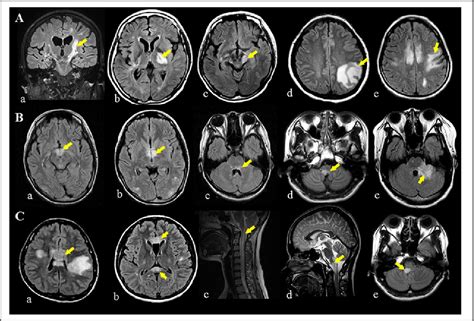 Figure 1 From The Usefulness Of Brain Mri At Onset In The