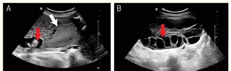 A B Ultrasound Scans Of A Patient With A Complete Hydatidiform Mole