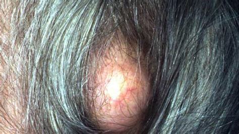 Pilar Cyst Causes Treatment And Removal