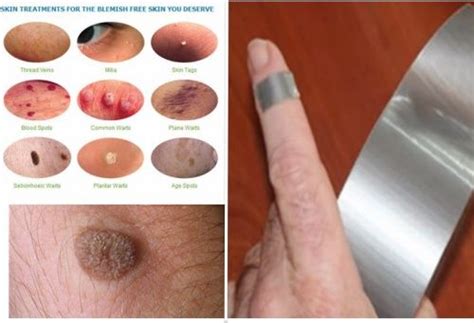 People get warts through direct contact with hpv, of which there are many different types. Pin on Health