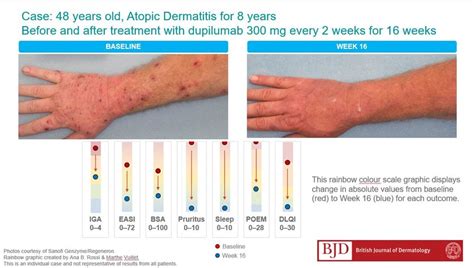 Example Of Case Before And After Treatment With Dupilumab 300mg Every