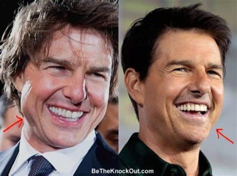 Tom Cruise Plastic Surgery Comparison Photos