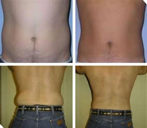 Albums Wallpaper Flank Liposuction Before And After Pictures
