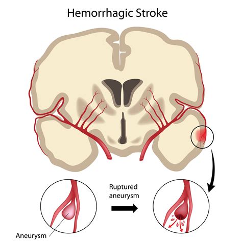 Hemorrhagic Stroke Pathophysiology Diagram Atkinsjewelry Images And