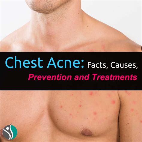 Chest Acne Facts Causes Prevention And Treatments Consumer Health Weekly