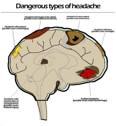 Types Of Headaches And When To Be Concerned Premier Neurology