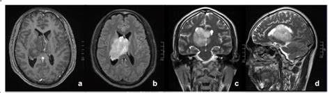 Mri Brain Contrast Showed A Large Fairly Defined Lobulated