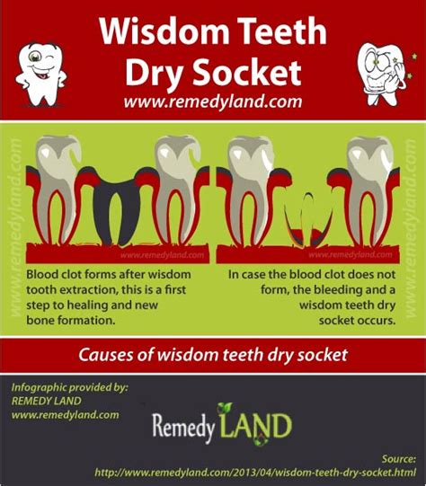Wisdom Teeth Dry Socket Treatment