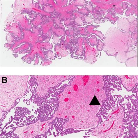 Bilateral Borderline Seromucinous Ovarian Tumors 25 Year Old Female