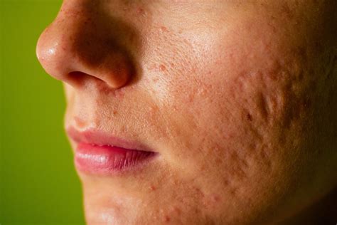 3d Imaging Technique Measures Severity Of Atrophic Acne Scars