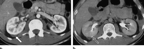 Right Renal Laceration Extending Into The Collecting System Grade Iv