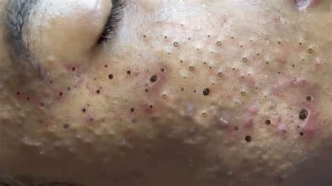 Removal Hidden Blackheads At Loan Nguyen Spa 32 Youtube