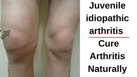 Juvenile Idiopathic Arthritis Cure Arthritis Naturally Youtube