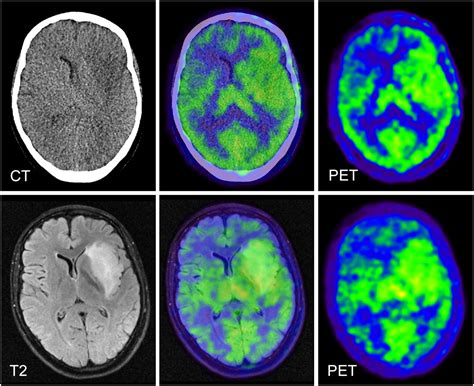 Hybrid Petmri Of Intracranial Masses Initial Experiences And