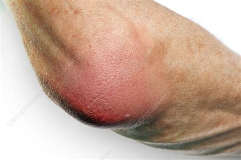 Bursitis Of The Elbow Stock Image C0238943 Science Photo Library