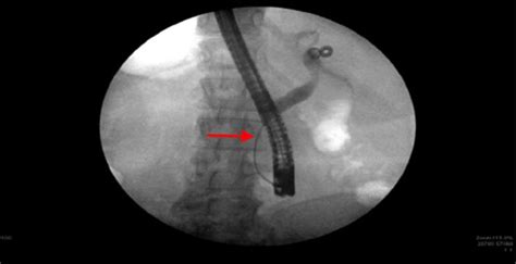 Ercp Showing A Distal Biliary Stricture Arrow Download Scientific