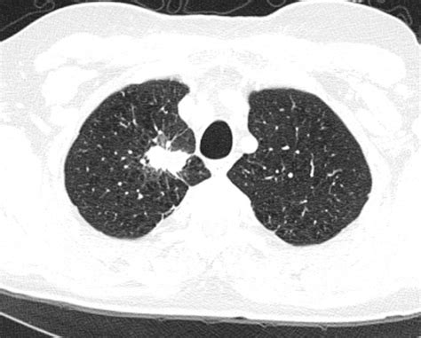 Primary Lung Cancer Radiology At St Vincents University Hospital