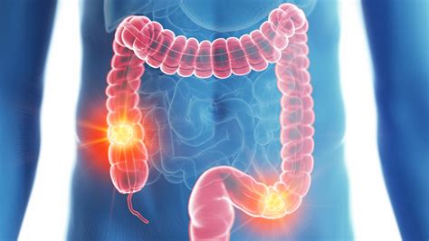 Colorectal Cancer As Related To Cancers Pictures