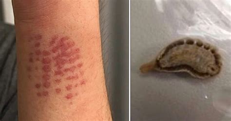 Sick Teen Complains Of Strange Red Mark On His Arm Mom Has Warning