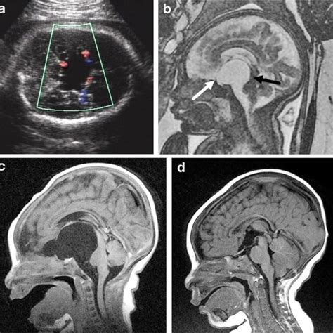 Isolated Mildmoderate Ventriculomegaly A Fetal Us In A 19 Week Fetus