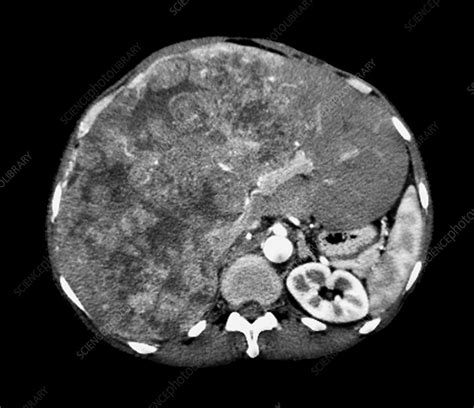 Liver Cancer Ct Scan Stock Image C0474064 Science Photo Library